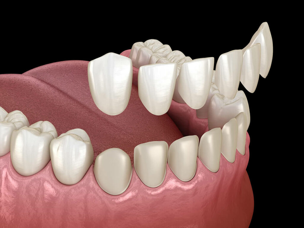 3D mockup of dental veneers fitting onto bottom front teeth