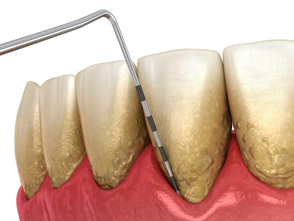 Illustration of gum disease on gums and teeth