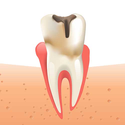 An illustration of a decaying tooth